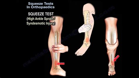 squeeze test sensitivity